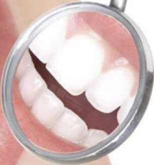 4x Teeth Whitening Trays Dental Whitener Oral Tooth Beaching Mouldable gum tray