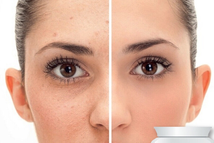 DR COMPLEXION ANTI BLEMISH SOLUTION BLEMISH & PIMPLE PILLS CLEAR SKIN SPOT FREE