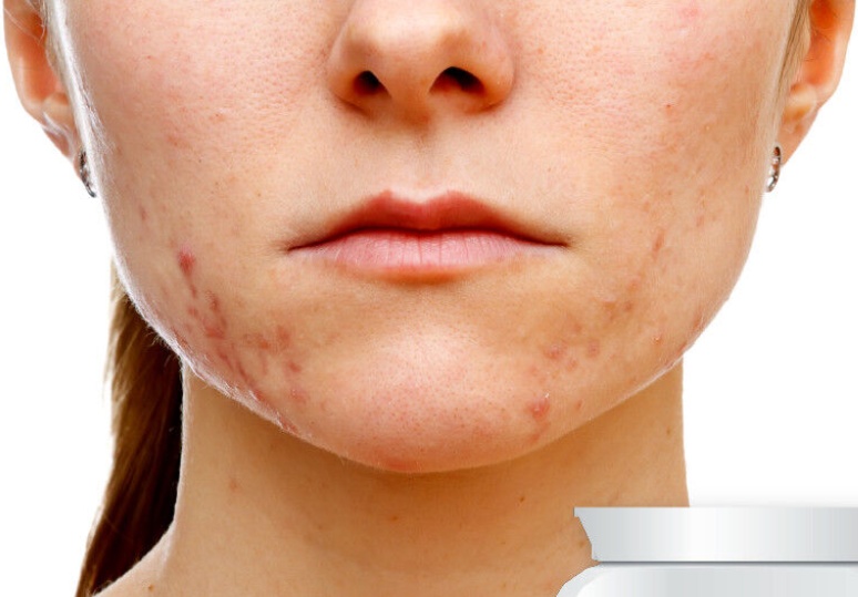 DR COMPLEXION TARGETED BREAKOUT CORRECTOR ACNE PILLS EXTREME STRENGTH SPOTS
