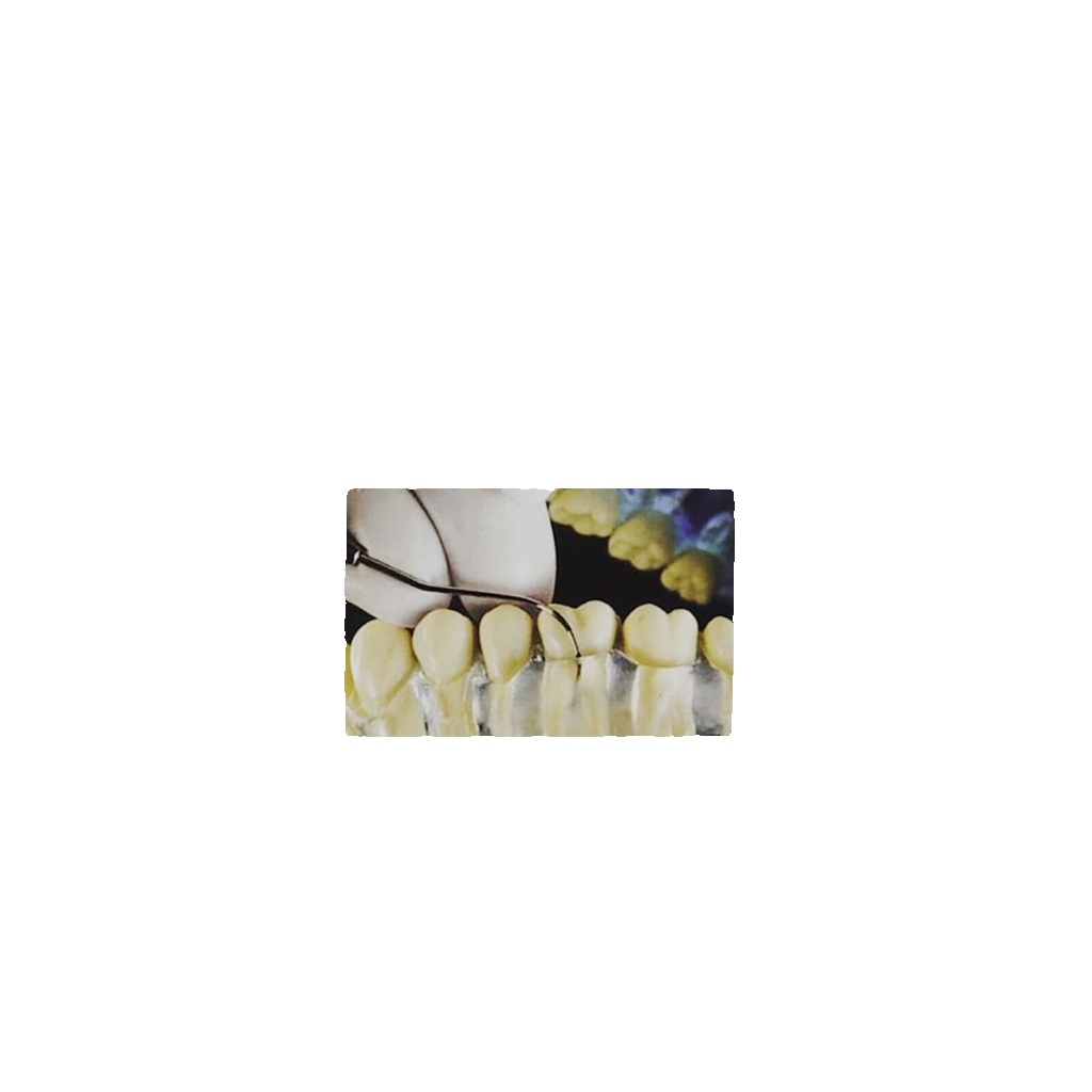 Nabers PSR Screening Colour Coded Probe Examination Periodontal Dental