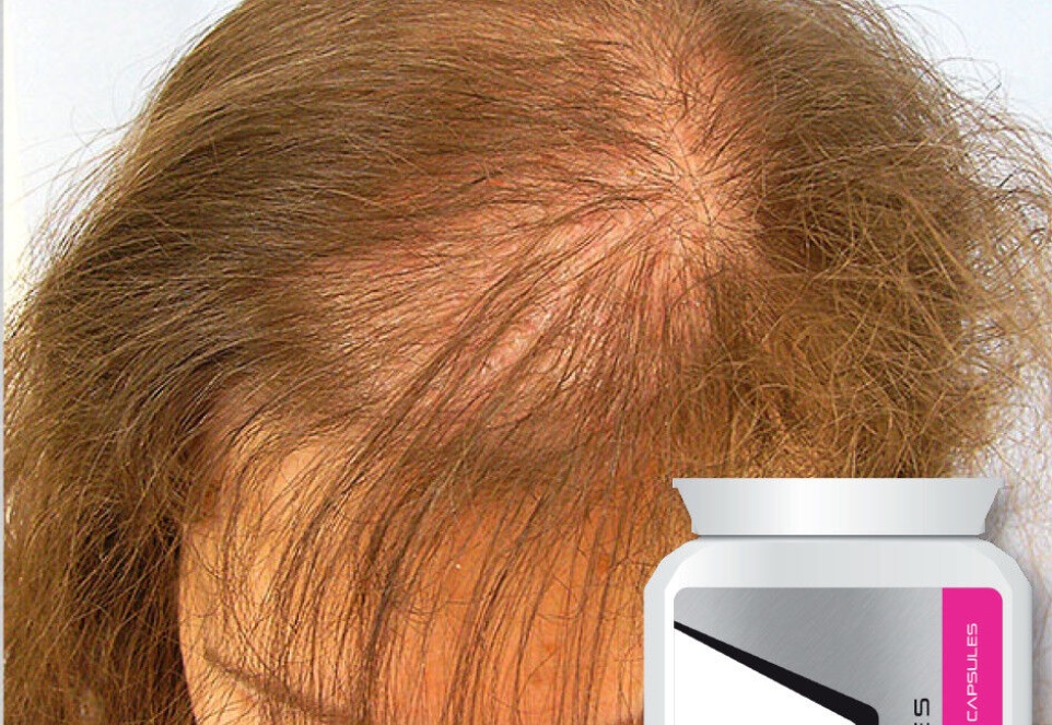 PRO-GROWTH WOMENS HAIR FOLLICLE STIMULATING PILLS HAIR RE GROW CAPSULES FAST