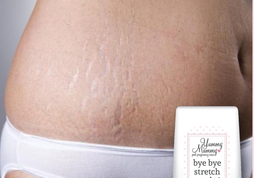 YUMMY MUMMY POST PREGNANCY CARE STRETCH MARK CREAM STOP & REMOVE MARKS