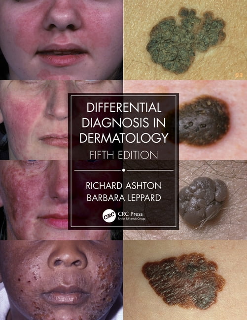 Differential Diagnosis in Dermatology by Richard Ashton, Barb... - 9780367085971